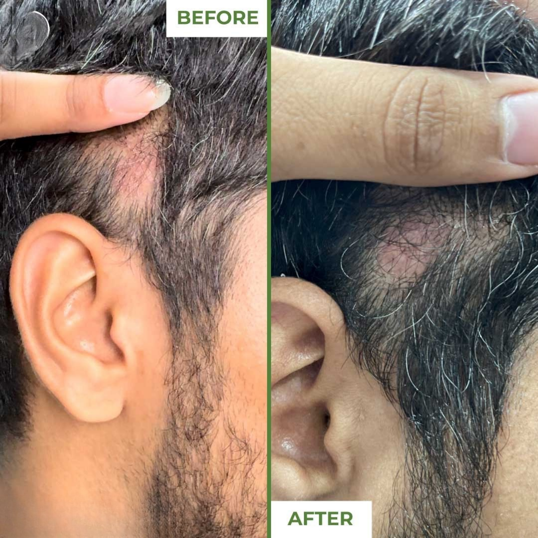Derma Roller 0.5mm