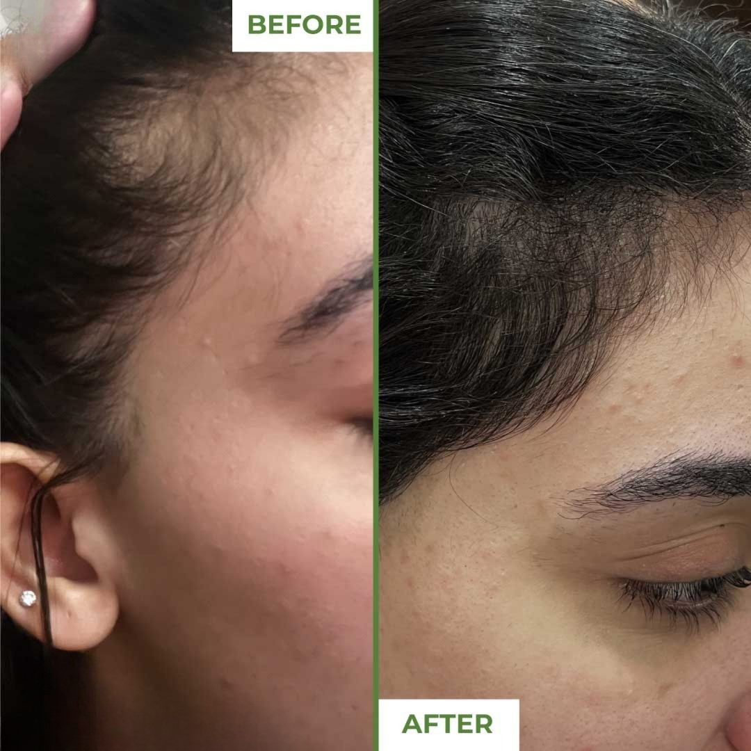Derma Roller 0.5mm