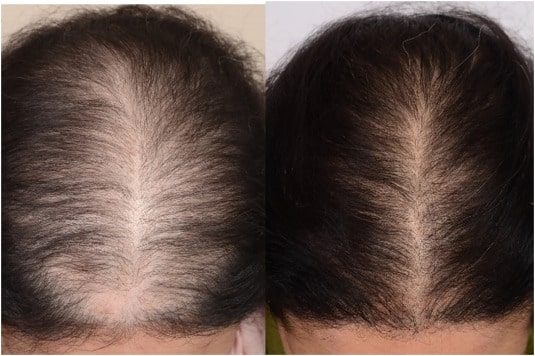 Adivasi Neelabari Herbal Hair Oil