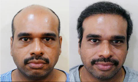 Adivasi Neelabari Herbal Hair Oil