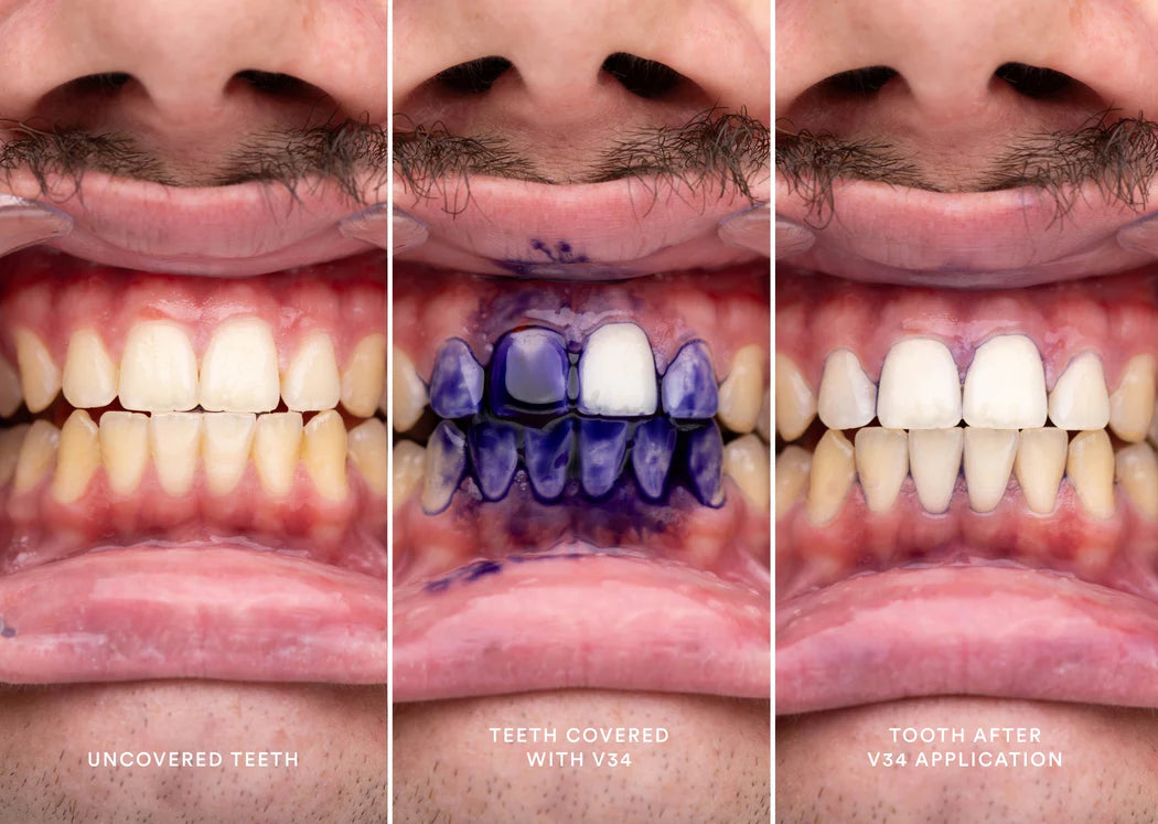 HiSmile V34™ – No More Yellow Stains, Just Bright Smiles