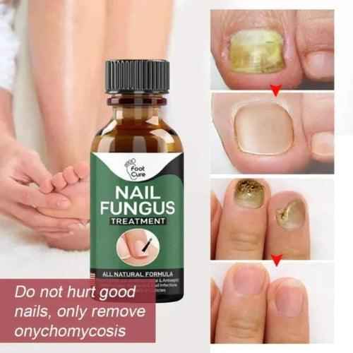Nail Fungus Treatment Serum Fast Acting Antifungal Solution for Healthy Nails