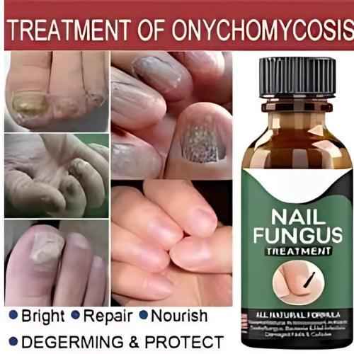 Nail Fungus Treatment Serum Fast Acting Antifungal Solution for Healthy Nails